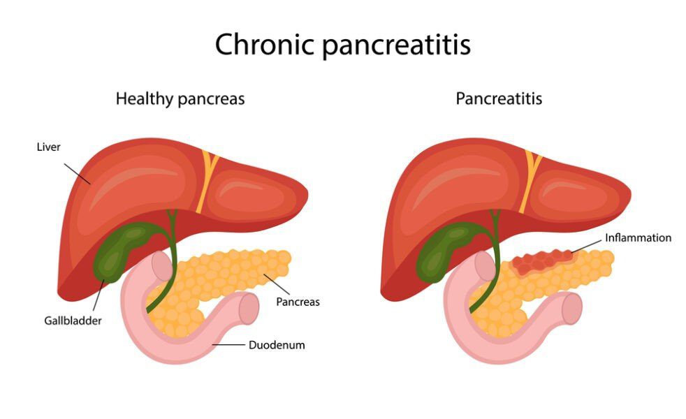 Pancreatite crônica