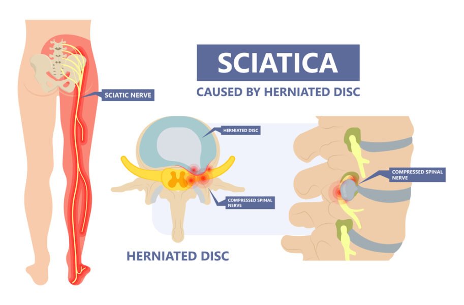 sciatica pain