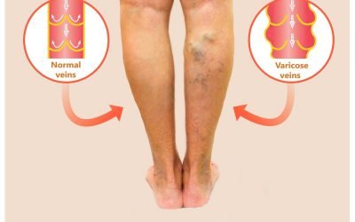 Guidelines for Varicose Veins According To ICD 10