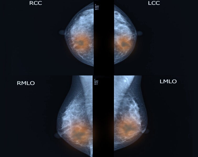 mamogram
