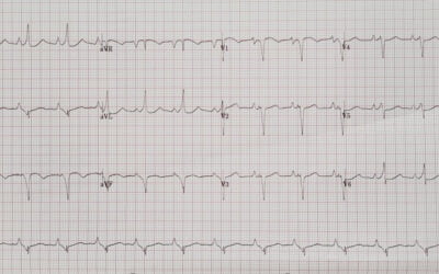 Síndrome de Wolff Parkinson White: sintomas e tratamento