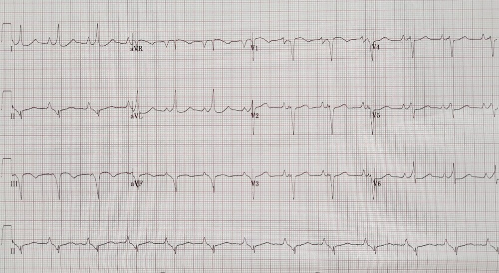 Sindrom Putih Wolff Parkinson: Gejala dan Pengobatan