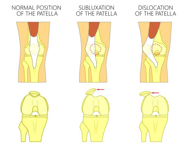 Patellar Subluxation