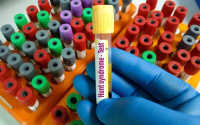 Ramsay Hunt Syndrome Natural Treatment : Experts View