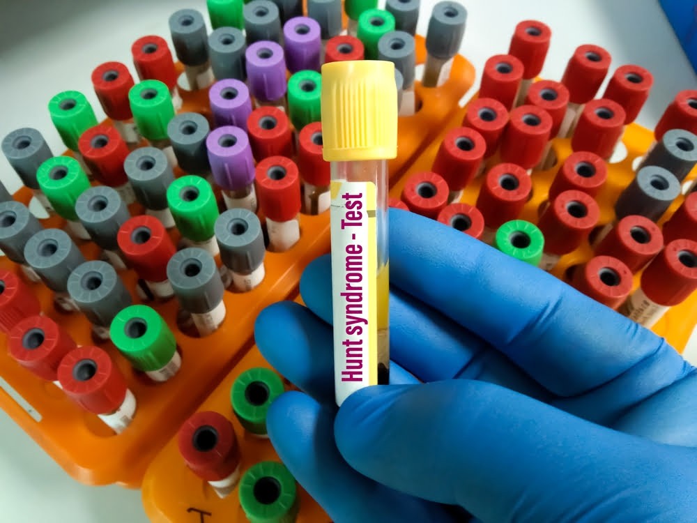 Perawatan Alami Sindrom Ramsay Hunt : Pandangan Ahli