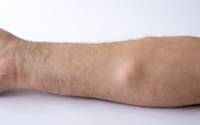 Diet untuk lipoma: makanan terbaik untuk dimakan dan dihindari