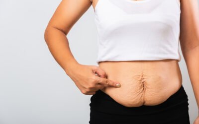 Cara menghilangkan kulit kendur setelah penurunan berat badan tanpa operasi