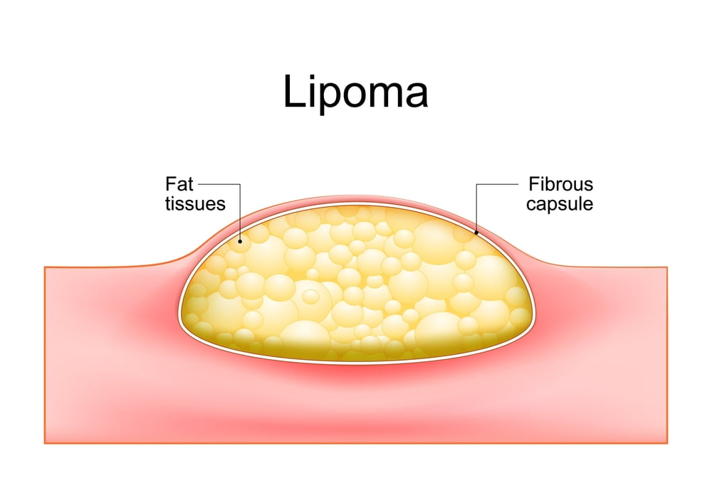 lipoma