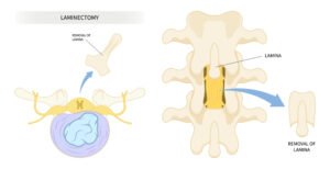 Exercises to Avoid After a Lumbar Laminectomy