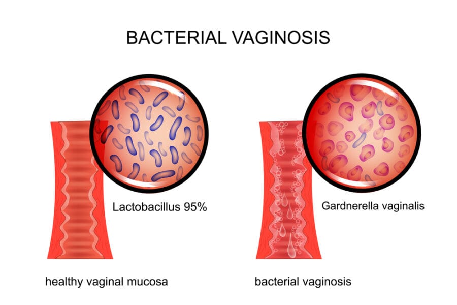 Vaginose bacteriana