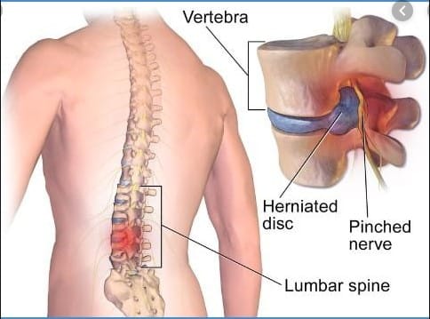Spondilosis lumbal
