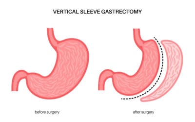 Apa itu Manga Gastrica: Prosedur, Efek Samping, Pemulihan dan Biaya