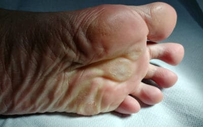 Apa perbedaan antara jagung dan kutil: kondisi kulit umum