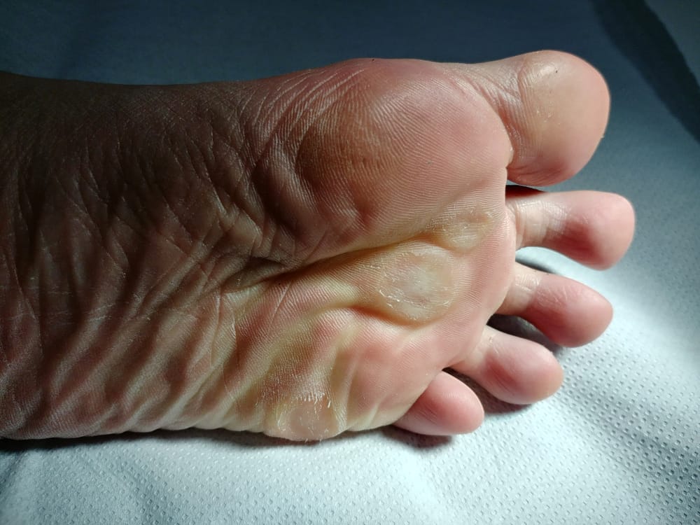 ما هو الفرق بين الذرة والثآليل: حالة جلدية شائعة