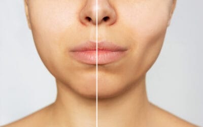 Por que minhas bochechas parecem gordas quando sorrio: 10 razões