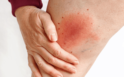 A doença de Lyme pode causar ganho de peso?