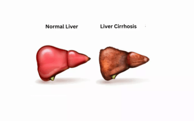 Liver Cirrhosis Treatment and Prevention: Protecting Your Liver for Life Liver Cirrhosis Treatment and Prevention