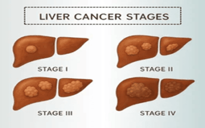 Stage-Wise Liver Cancer Management